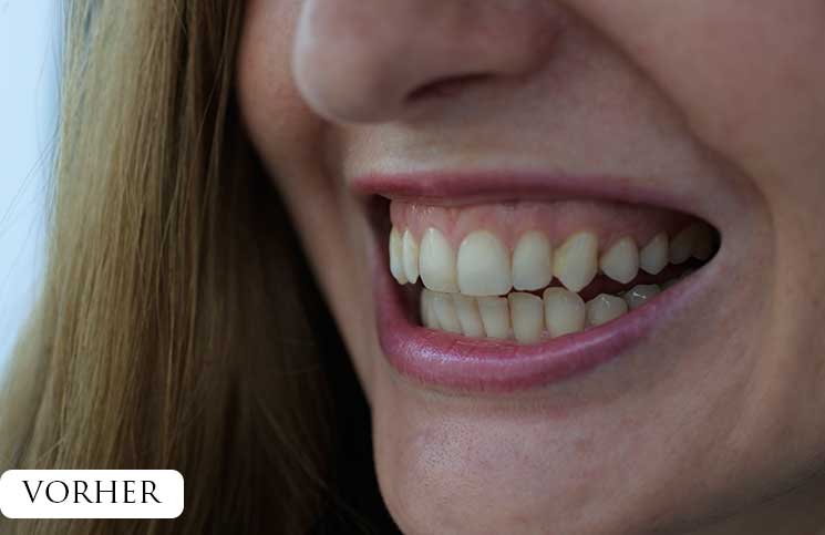 Zähne-bleachen-endlich-weiße-Zähne-vor-dem-aufhellen